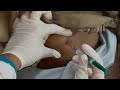 Intramuscular injection #injection #neet #mbbs #nursing #nursingofficer #gnm