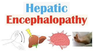 Hepatic Encephalopathy | Pathophysiology, Triggers, Signs & Symptoms, Diagnosis, Treatment