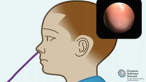 Flexible nasoendoscopy and velopharyngeal insufficiency (VPI)