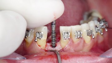 Straumann BLT 2.9 mm - Lower incisor implant and immediate provisional