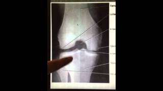 Intercondylar Fossa (Beclere Method)