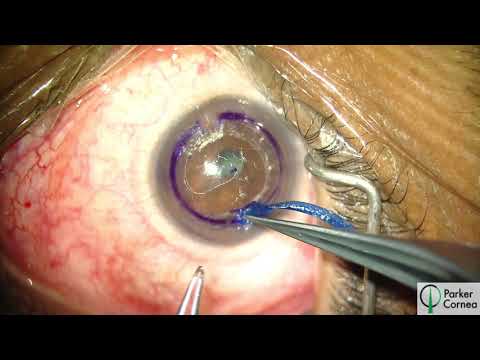 Manual CAIRS - Corneal Allogenic Intrastromal Ring Segment Implantation for Keratoconus