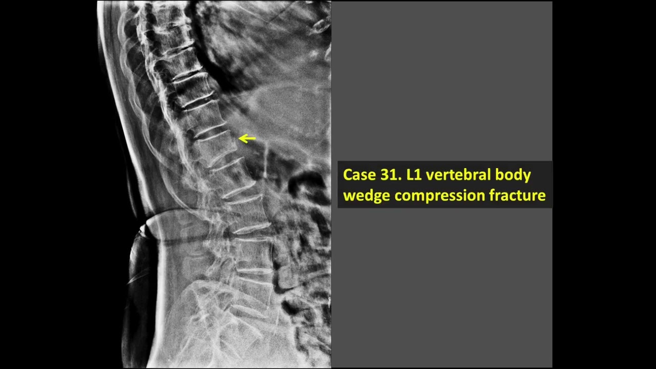 L1 Vertebral Body Wedge Compression Fracture X Ray YouTube L1 Vertebral Body Wedge Compression Fracture X Ray YouTube