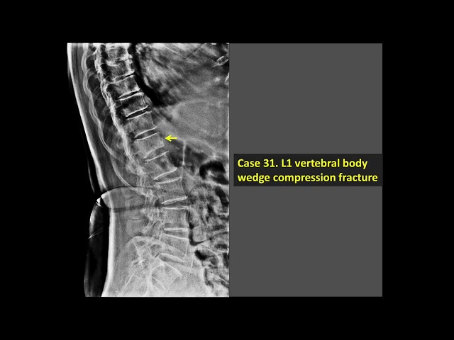 X-Ray Case 31 - L1 Vertebral Body Wedge Compression Fracture