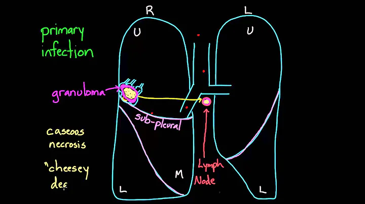 Primary and Secondary TB - DayDayNews