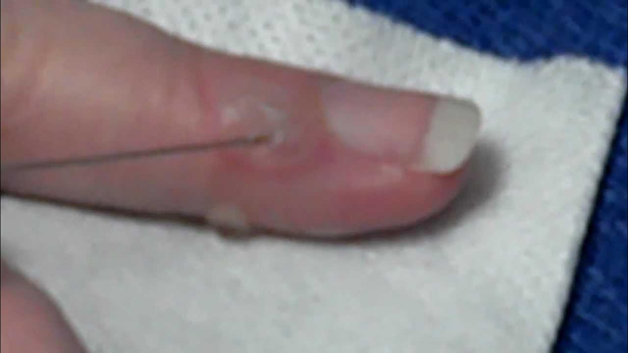 Popping my burn blister YouTube