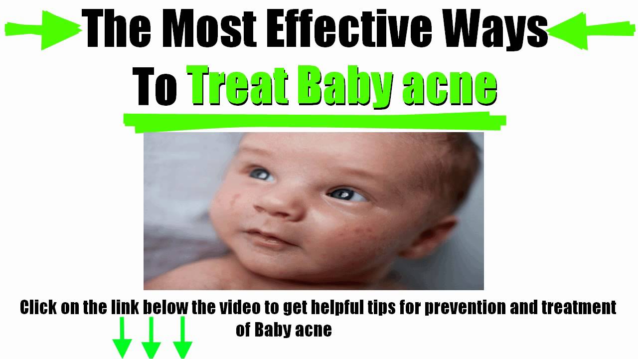 How do you treat baby acne?