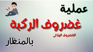 عملية غضروف الركبة ( الغضروف الهلالى ) بالمنظار - دكتور عصام عاصى