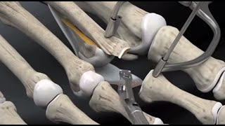 About Crossover Toe