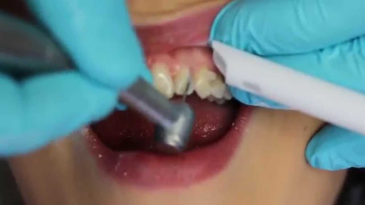 How to remove invisalign