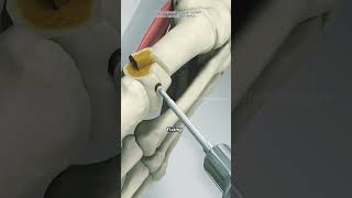 Bunion Correction Surgery (3D Animation)