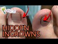 HIDDEN INGROWN NAILS - BIGGER THAN EXPECTED!!