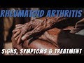Rheumatoid Arthritis Do You Have It? - Must See Video for Signs, Symptoms & Treatment