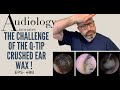 THE CHALLENGE OF THE Q-TIP CRUSHED EAR WAX - EP488