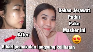 Masker Untuk Menghilangkan Bekas Jerawat