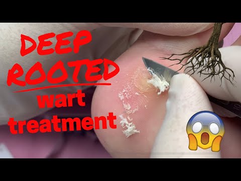 DEEP Rooted Wart Treatment