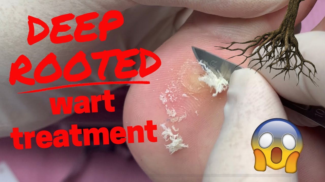 Deep Rooted Wart Treatment Youtube