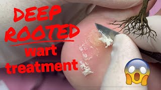 DEEP Rooted Wart Treatment