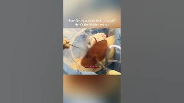 Knee Arthroscopy: Uncovering a Hidden Meniscus Tear #MoraMD
