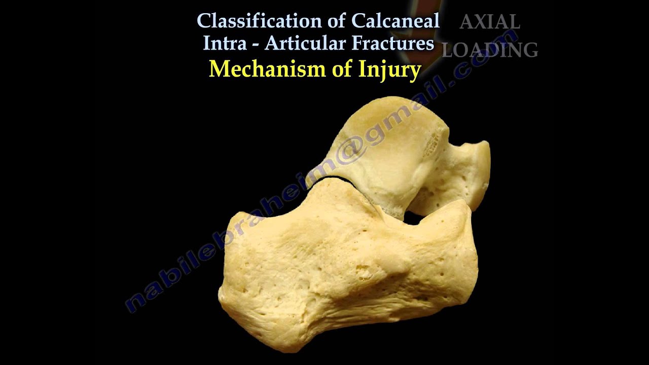 Fracture Care Treatment: When is a cast not good enough?