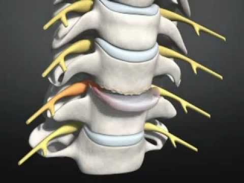 Operation Zervikale Bandscheibenprothese-Halswirbelsäule - YouTube
