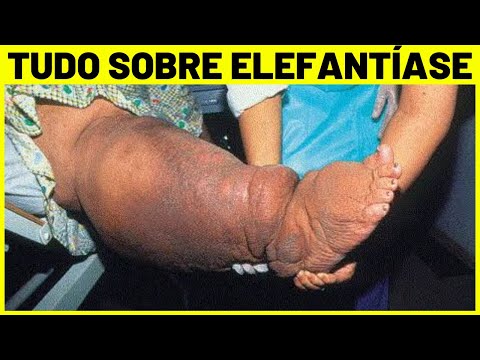 ELEFANTÍASE (FILARIOSE) - O QUE É, SINTOMAS E TRATAMENTO