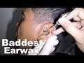 Removing Man's Baddest Earwax - Watch How It's Done