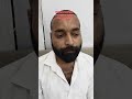 Hairtransplant 48 Hours After Final Wash Result #hairtransplant #hairrestoration #hairtransformation