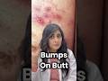 Butt Acne Butt Pimples Dark Spots On Back Butt Acne Butt Pimples Dark Spots On Back