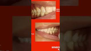 25 years old female with generalized spacing visit the treatment plan link here https://rb.gy/tp4si8