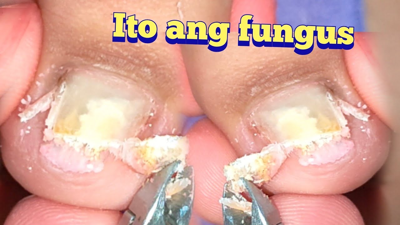 HOW TO PEDICURE A TOENAIL FUNGUSRESTORATION PROCESS 🐾 YouTube