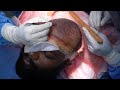 Live Hair Transplant Procedure 2021 | Best Hair Transplant in india | Richardsons Hospital