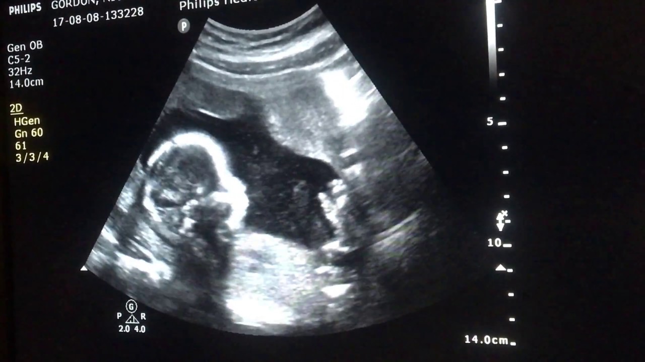 Milenium Home Tips: Baby At 19 Weeks Ultrasound