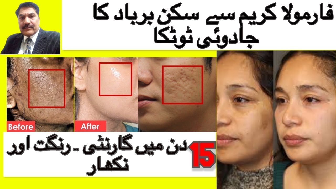 Pimples Ka ilaj Face Acne Ka ilaj Chehre Par Dano Ka Skin Par