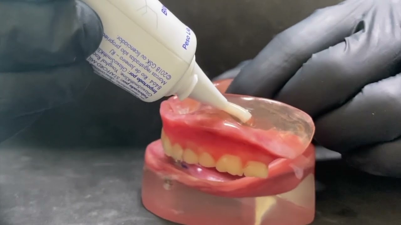 Dentadura presa por 2 implantes e o uso do Corega