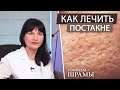 Как лечить постакне. Убираем рубцы и шрамы. Правильный уход за кожей