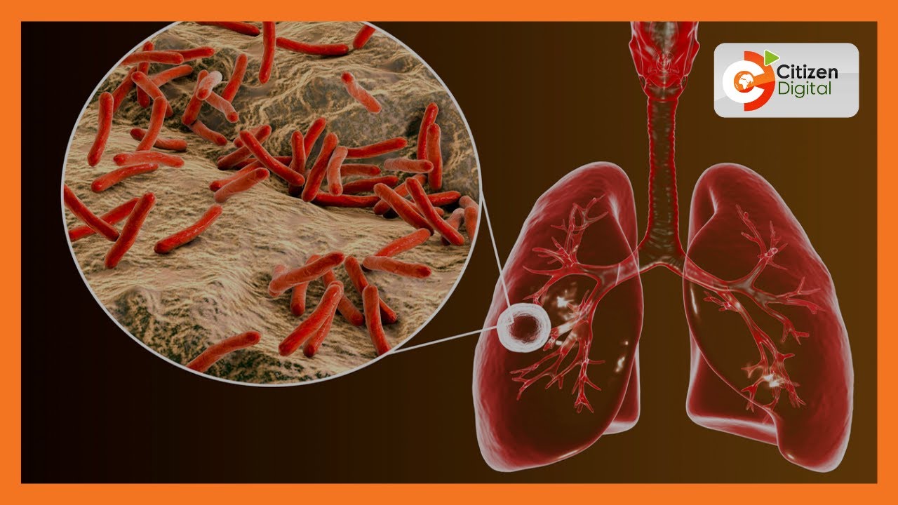 Jukwaa la Afya: Mdahalo kuhusu ugonjwa wa kifua kikuu (Sehemu ya Kwanza)