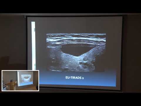 Echographie Thyroidienne: Nouvelle