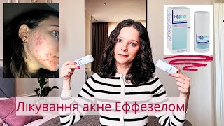 мій досвід лікування акне Еффезелом: чи допоміг мені, як уникнути опіків