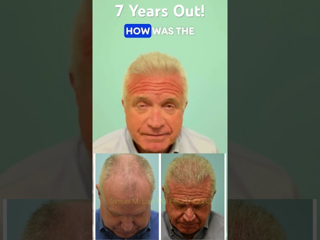 7 Year After Before and After Hair Transplant Result, Testimonial, and Closeup Comb-Through Shown