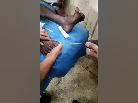 k-Wire Fixation, orthopedics - YouTube