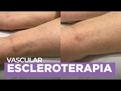 Video: Consecuencias de descuidar el tratamiento de las varices