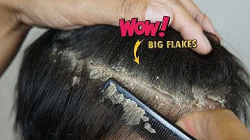 Itchy Dry Scalp Scratching Dandruff On My Brother