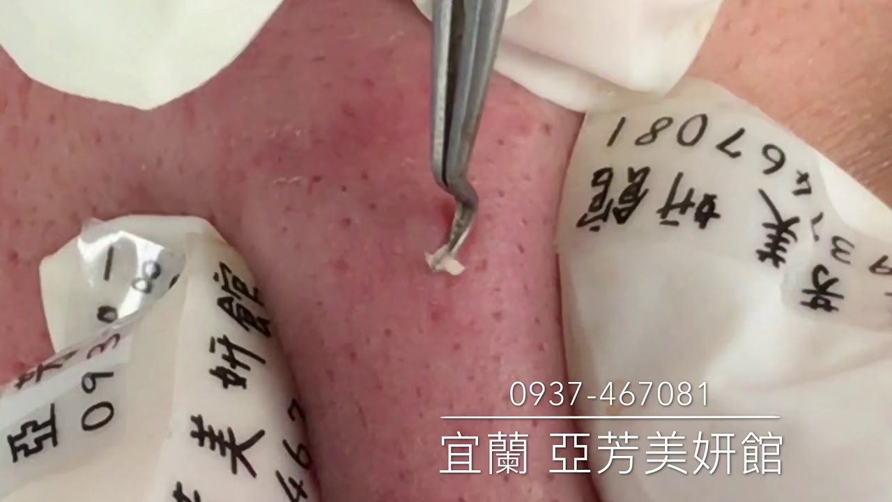 顔の毛穴から白いニュルニュルを取り出す美容サロンの映像が大人気に 1000mg 顔の毛穴から白いニュルニュルを取り出す美容サロンの映像が大人気に 1000mg