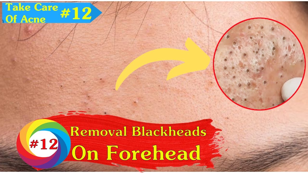 Pimples Removal Blackheads On Forehead | Take Care Of Acne (#12)
