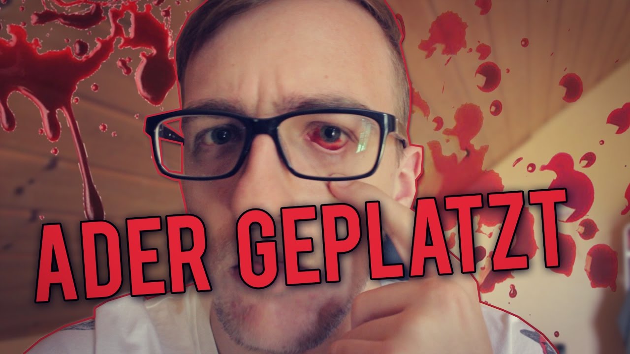 Ader im Auge geplatzt | Realstory - YouTube