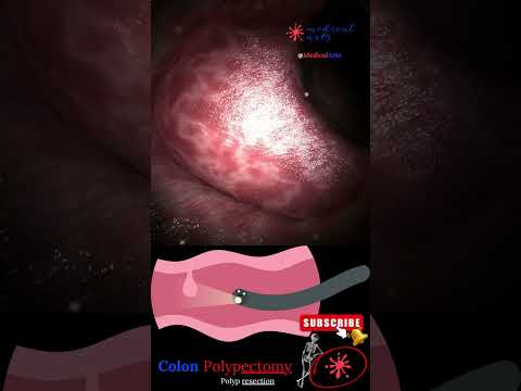 Coloscopy | Colon Polyp Resection | Polypectomy