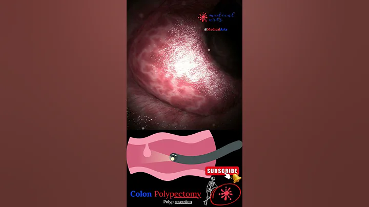 Coloscopy | Colon Polyp Resection | Polypectomy - DayDayNews