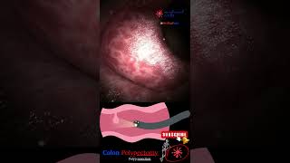 Coloscopy | Colon Polyp Resection | Polypectomy screenshot 1