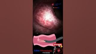 Coloscopy | Colon Polyp Resection | Polypectomy